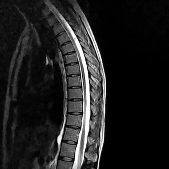MRI Thoracic Lumbar Spine Test